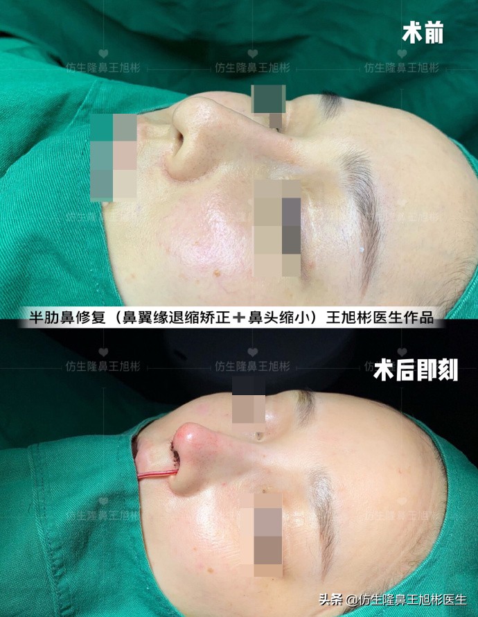 鼻中隔重塑鼻头,鼻中隔重建整形