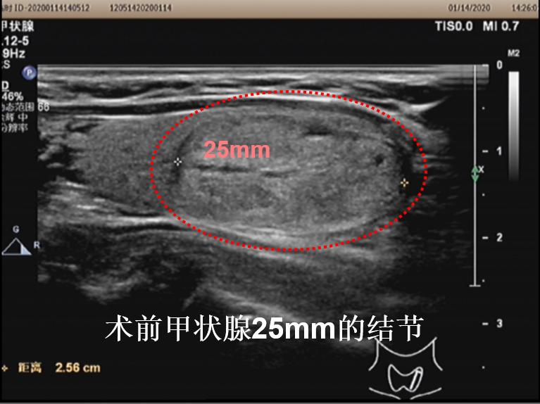 甲状腺结节微创消融手术,甲状腺结节微创消融医保