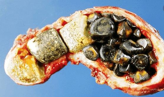 胆结石做了二次开腹还能做微创不,胆结石微创手术与传统手术对比