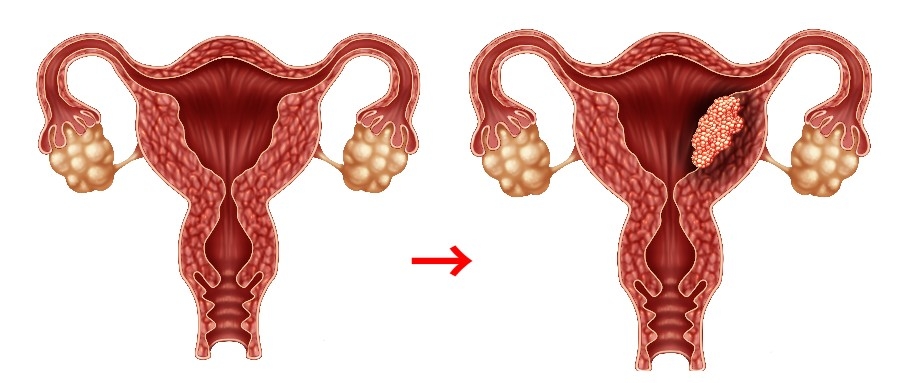 有两个孩子的妈妈得上胃癌,生了三个孩子患子宫内膜癌