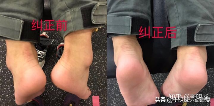 足内翻如何通过调整走路姿势改正,纠正足内翻教你一招