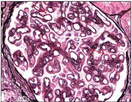 膜性肾病的尿蛋白，为何这么难消除？
