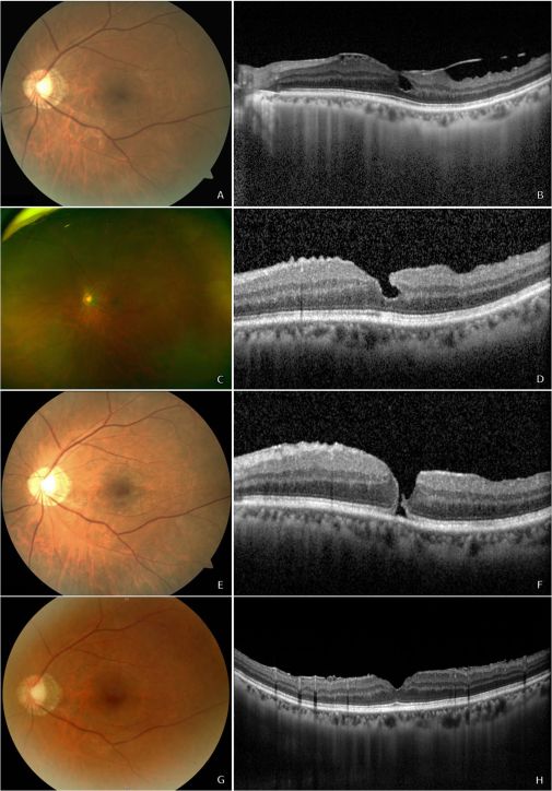 视网膜脱落玻璃体切割术后并发症,眼科黄斑裂孔病例