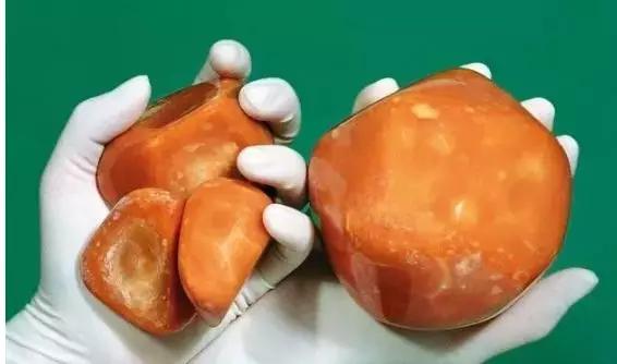 小结石大结石哪个严重,强回声胆结石