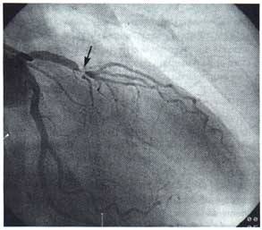 心肌缺血心跳加速是什么原因,老年人心肌缺血是什么原因造成的