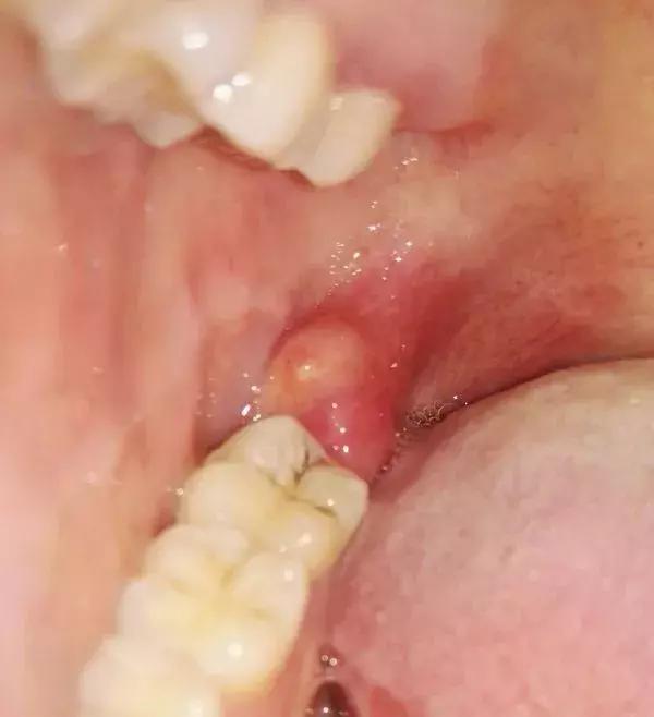 那些不拔智齿的人后来都怎么样了,那些该拔不拔的智齿最后都咋样了