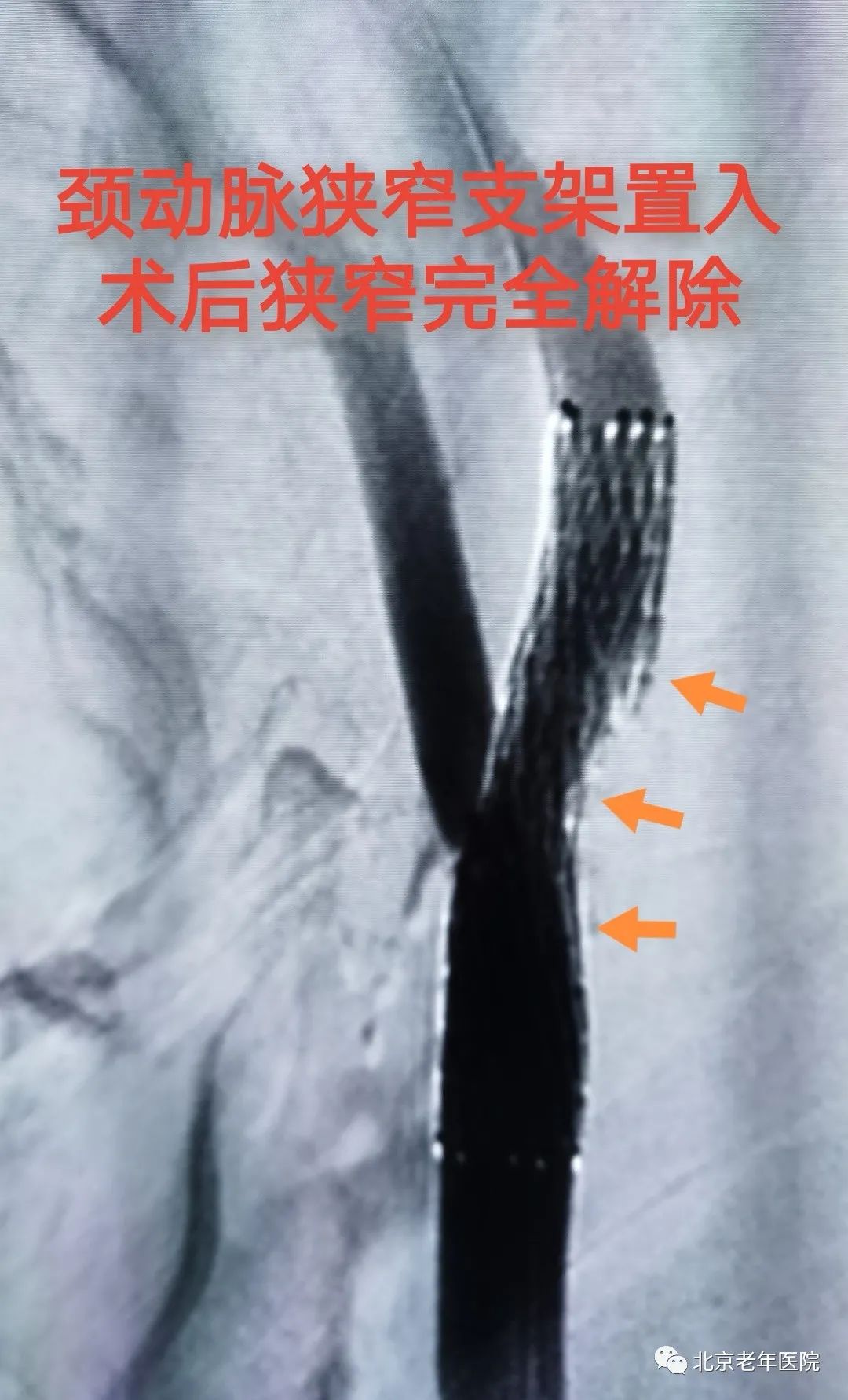 血管狭窄引起脑卒中需要下支架吗,80岁脑血管狭窄有必要做支架吗