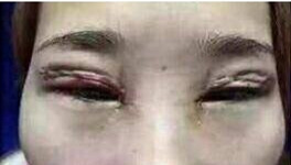 不割不埋线的双眼皮纳米技术,纳米无痕双眼皮和非手术区别