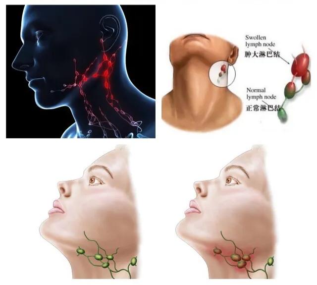 颈部摸到淋巴结凸起是肺坏了吗,颈部淋巴结肿大良性和恶性的区别