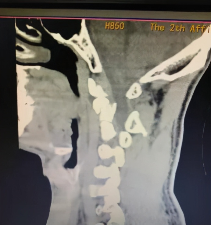 颈椎粉碎性骨折,颈椎粉碎性骨折后期康复