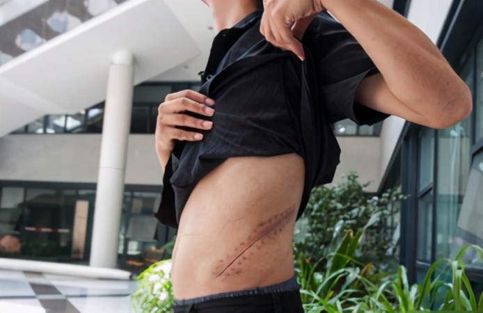 大学生卖肾换手机,8年前卖肾的小伙子现状