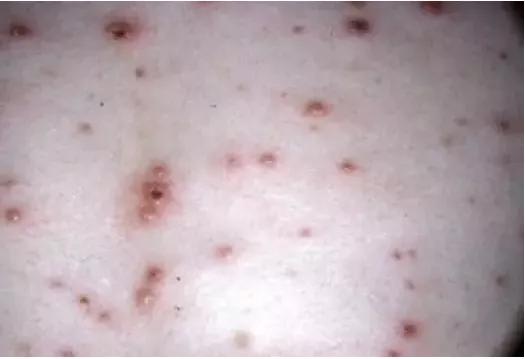 扁平疣和黑色素痣区别,疣与色素痣的区别