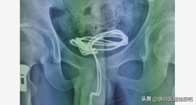 青少年有血尿怎么回事,青少年突然尿血和便血是怎么回事