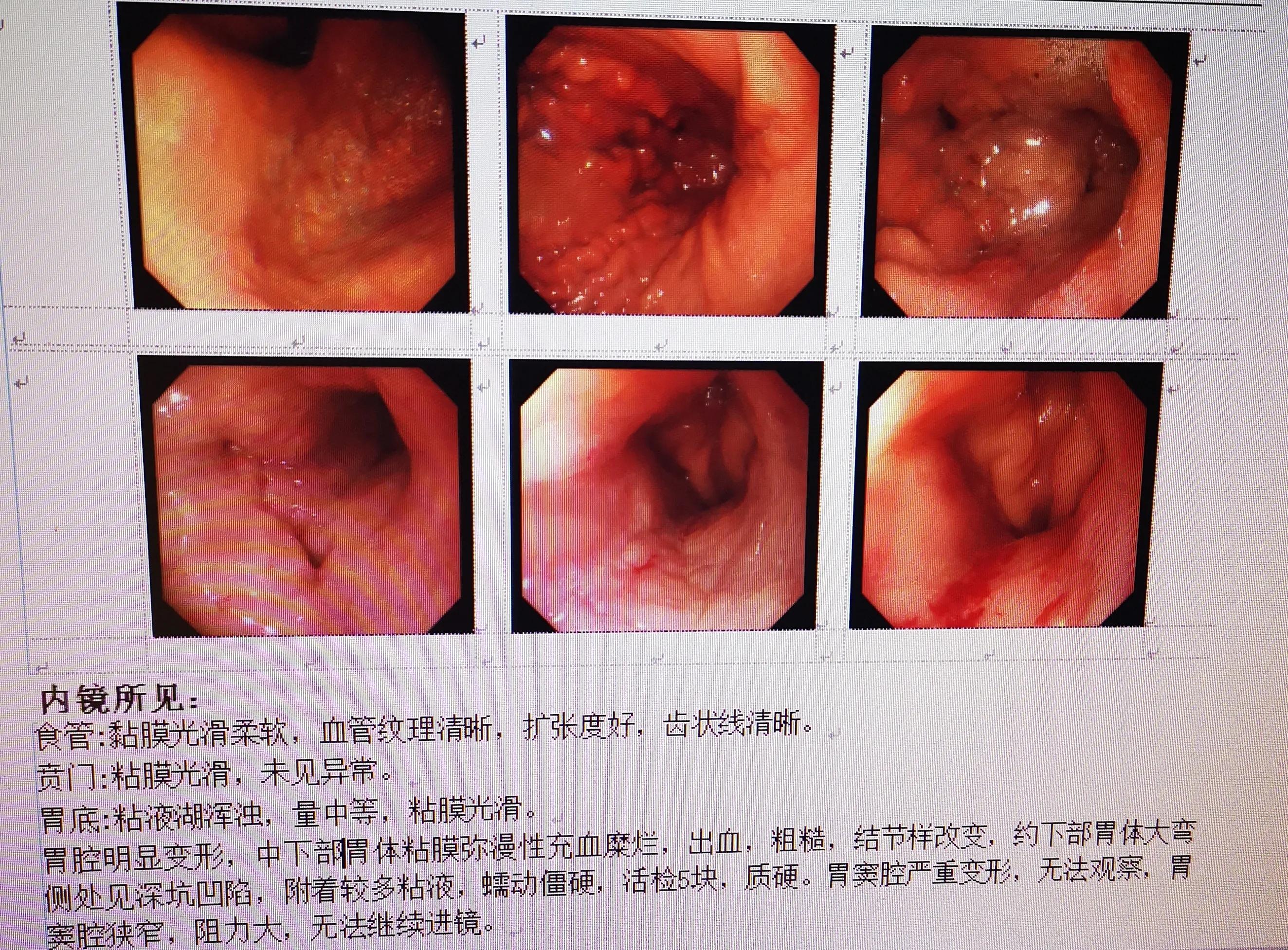39岁女人胃癌晚期,40岁女人胃癌晚期症状