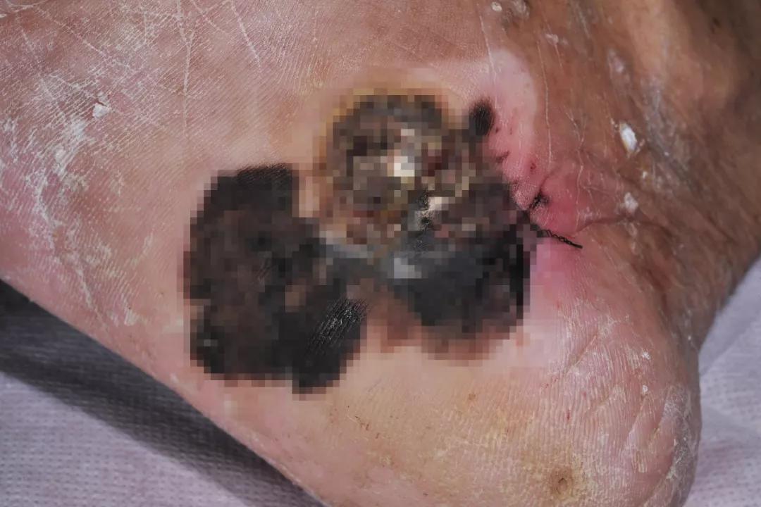 痣能点吗,我的痣凸起来会癌变吗