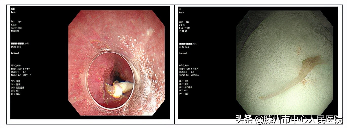 内镜下成功取出食管异物,消化内科取异物