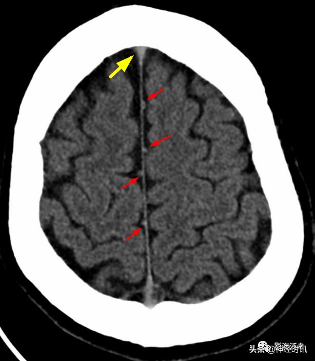 蛛血的临床表现,蛛血ct表现