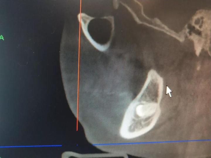 智齿一定要拔吗4种情况必拔,牙医出发最新视频智齿到底拔不拔