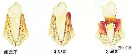 牙疼不是病疼起来真要命是真的吗,科普牙疼不是病疼起来真要命