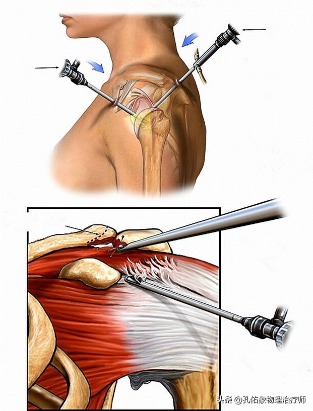 肩膀疼是肩周炎吗还是其他原因,肩周炎肩膀疼痛怎么锻炼