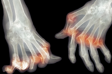 中医专家告诉你风湿与类风湿,中医怎样区分风湿和类风湿