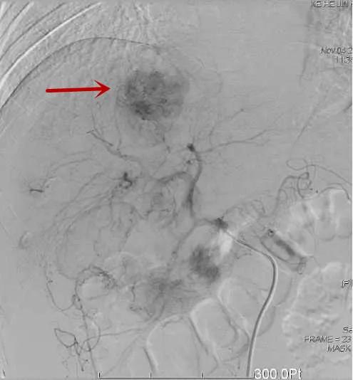 一产妇手术台上大出血死亡,一产妇大出血急需血小板去世