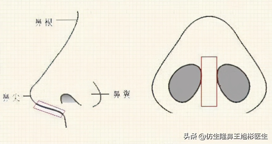 鼻头和鼻小柱是如何抬高的,鼻头扁是什么预兆