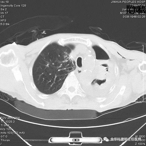 手术引起乳糜胸,有没有做了肺结节手术后是误诊的