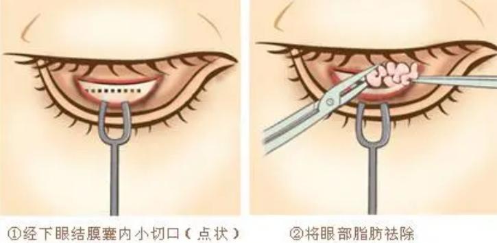 涂眼霜可以祛眼袋？不现实！祛眼袋的三种靠谱方法看这里
