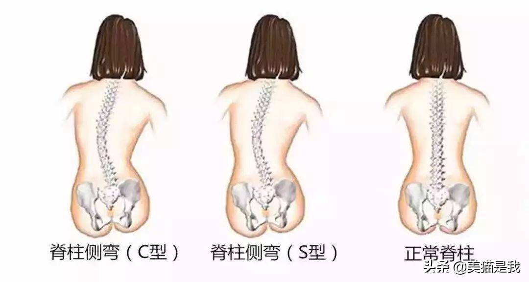 长短腿跟腿型能矫正吗,长短腿矫正锻炼方法左腿长右腿短