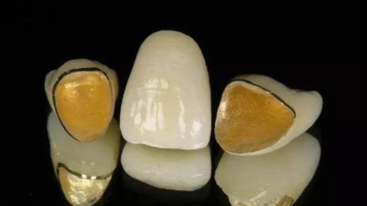 一般烤瓷牙与全瓷牙有什么区别,烤瓷牙和全瓷牙哪个性能更好