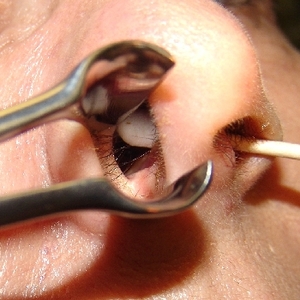 熊孩子鼻孔塞东西,熊孩子不断的向鼻子里塞恐龙