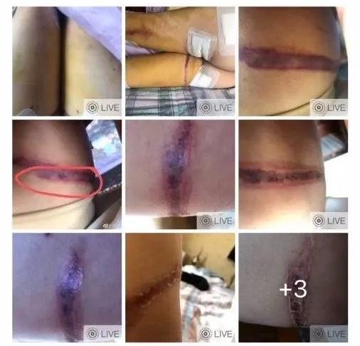 卫康医院抽脂,23岁女孩腿部吸脂手术失败