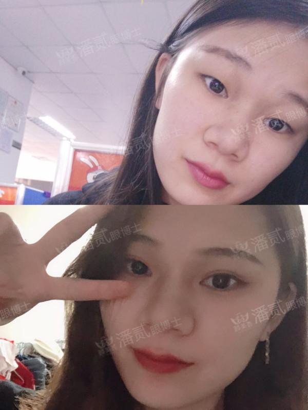 什么样的肿眼泡适合全切,什么样的肿眼泡不用动提肌