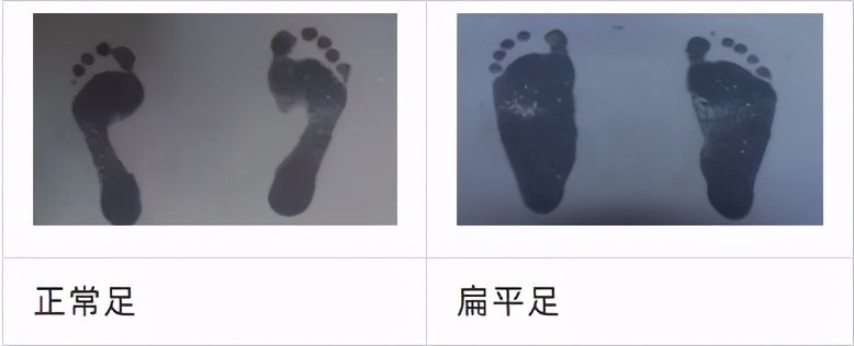 扁平足痛是什么感觉,扁平足是很严重的问题吗