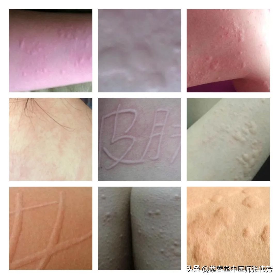 荨麻疹相关数据,荨麻疹的病历简短