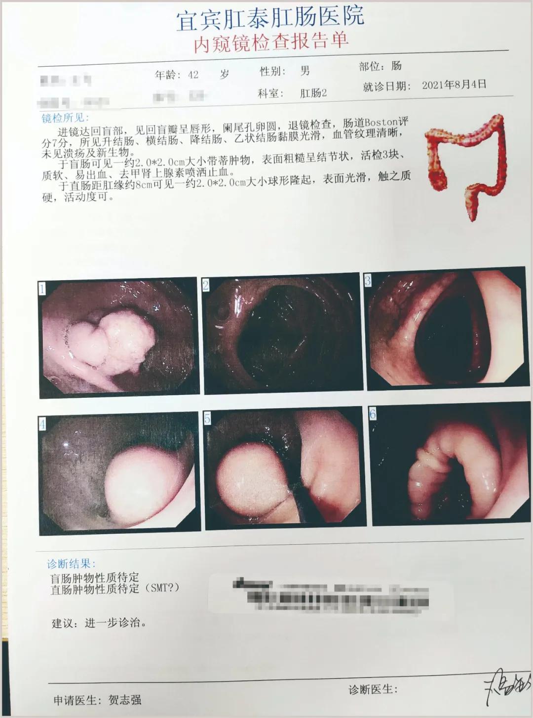 42岁男子行肠镜检查，竟查出二种瘤
