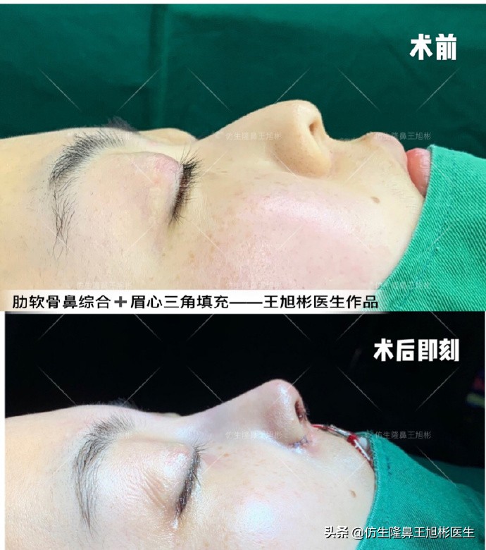 大鼻头能做直鼻微翘吗,可以只做鼻头缩小术吗