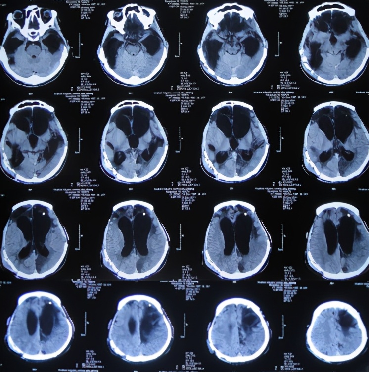 脑受伤开颅手术昏迷,开颅手术后20天发生脑积水引流