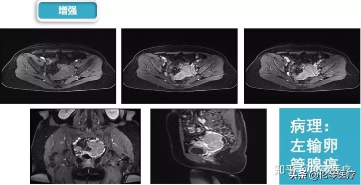 卵巢肿瘤核磁共振能看出来吗,超声测出来肿瘤