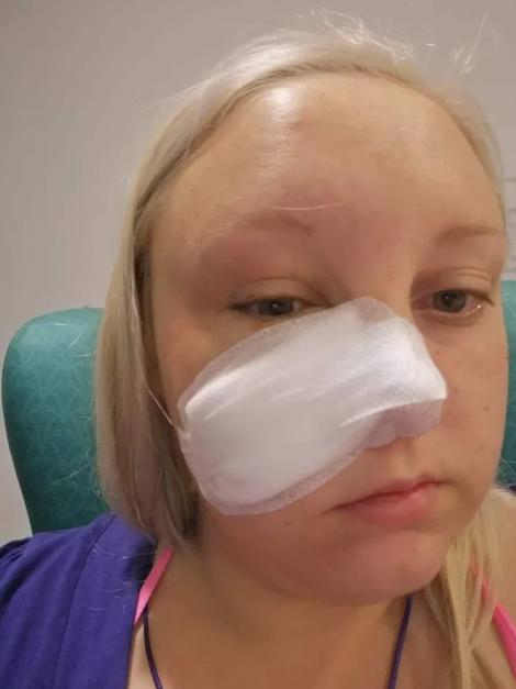 5岁女孩长水痘,成年人长水痘留下红印