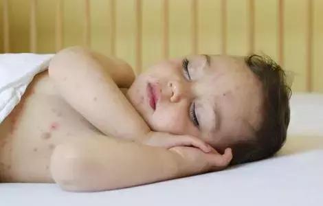 为什么宝宝爱起湿疹？得了湿疹又该如何护理？