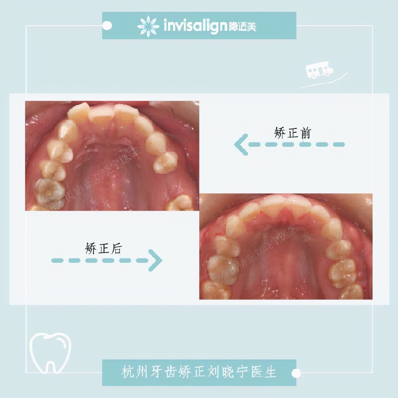 杭州牙齿矫正丨露龈笑怎么办?全面告别露龈笑的4大方法