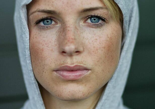 不伤皮肤的激光祛斑最真实的经历,激光祛斑反黑可以用维a酸乳膏吗