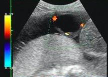 产检发现羊膜束带能干预吗,产检显示脐带粗怎么回事