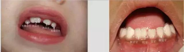 8岁宝宝牙齿长双排牙,1岁婴儿长双牙怎么办