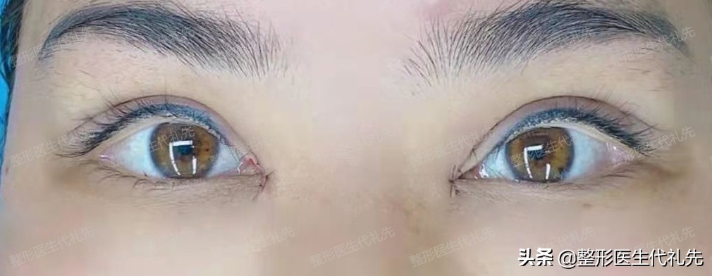 如何改善下垂眼单眼皮,单眼皮眼睑下垂的解决方法