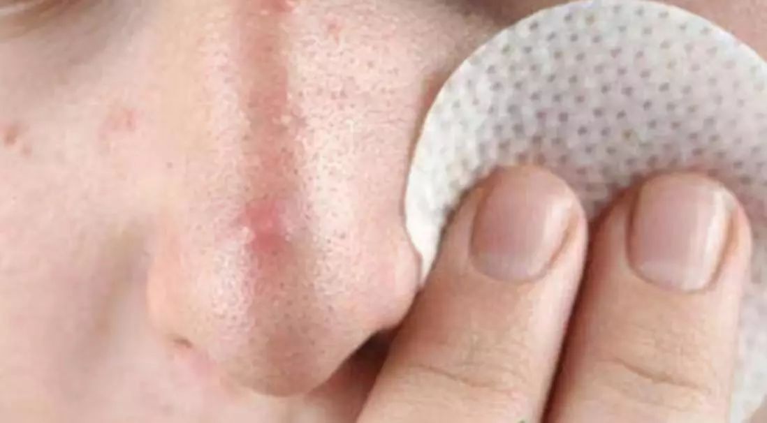 下巴和鼻子两侧老是反复长痘痘,鼻子里面长了一个痘痘怎么回事