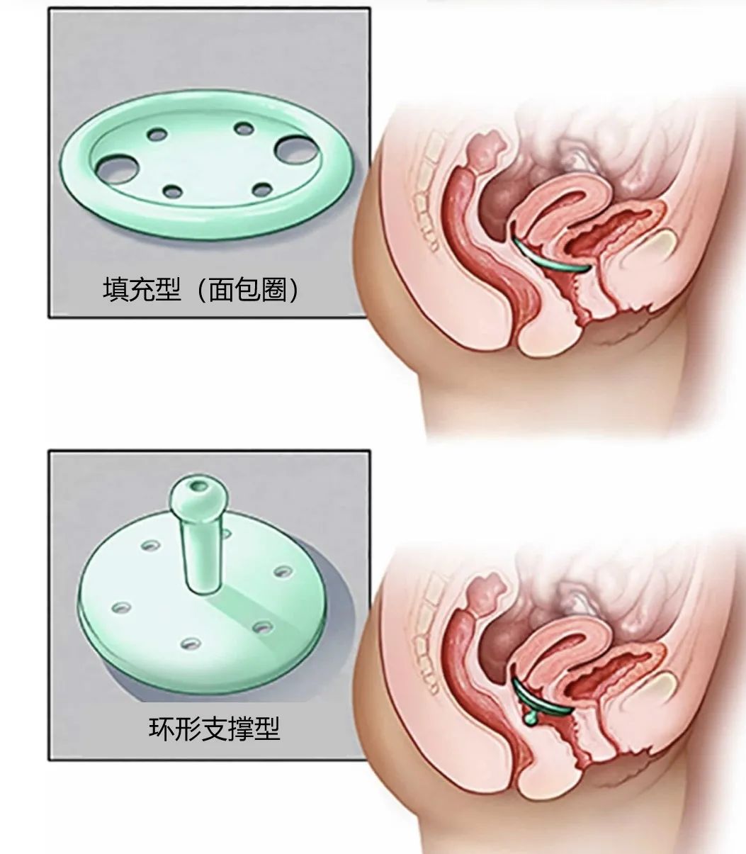 七旬老妪的难言之隐，其实可以这样预防