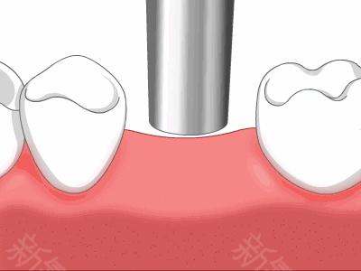 种植牙和烤瓷牙究竟有哪些区别?为什么都说种植牙好?